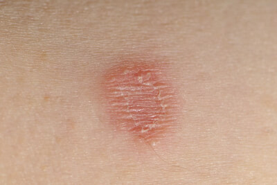 Вірусні інфекції шкіри