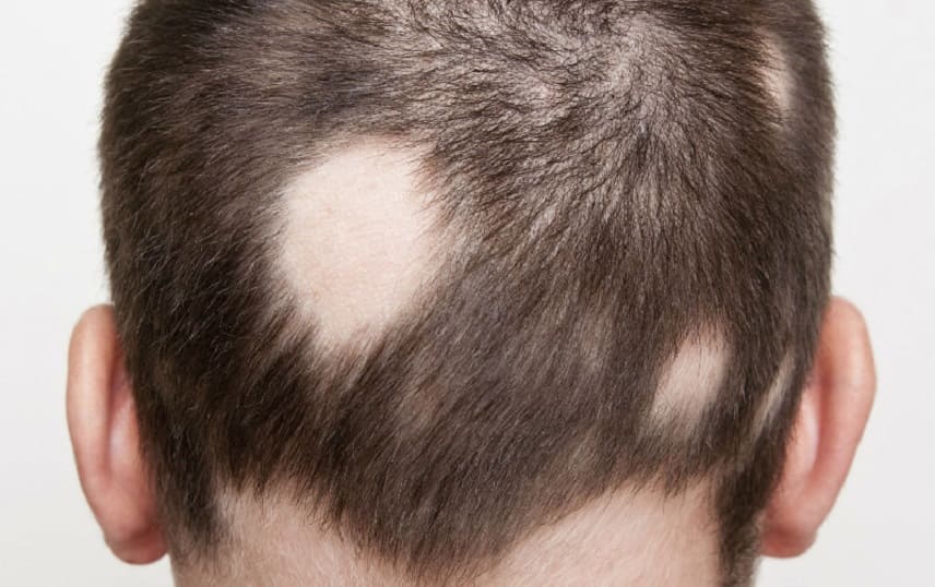 Вогнищева алопеція