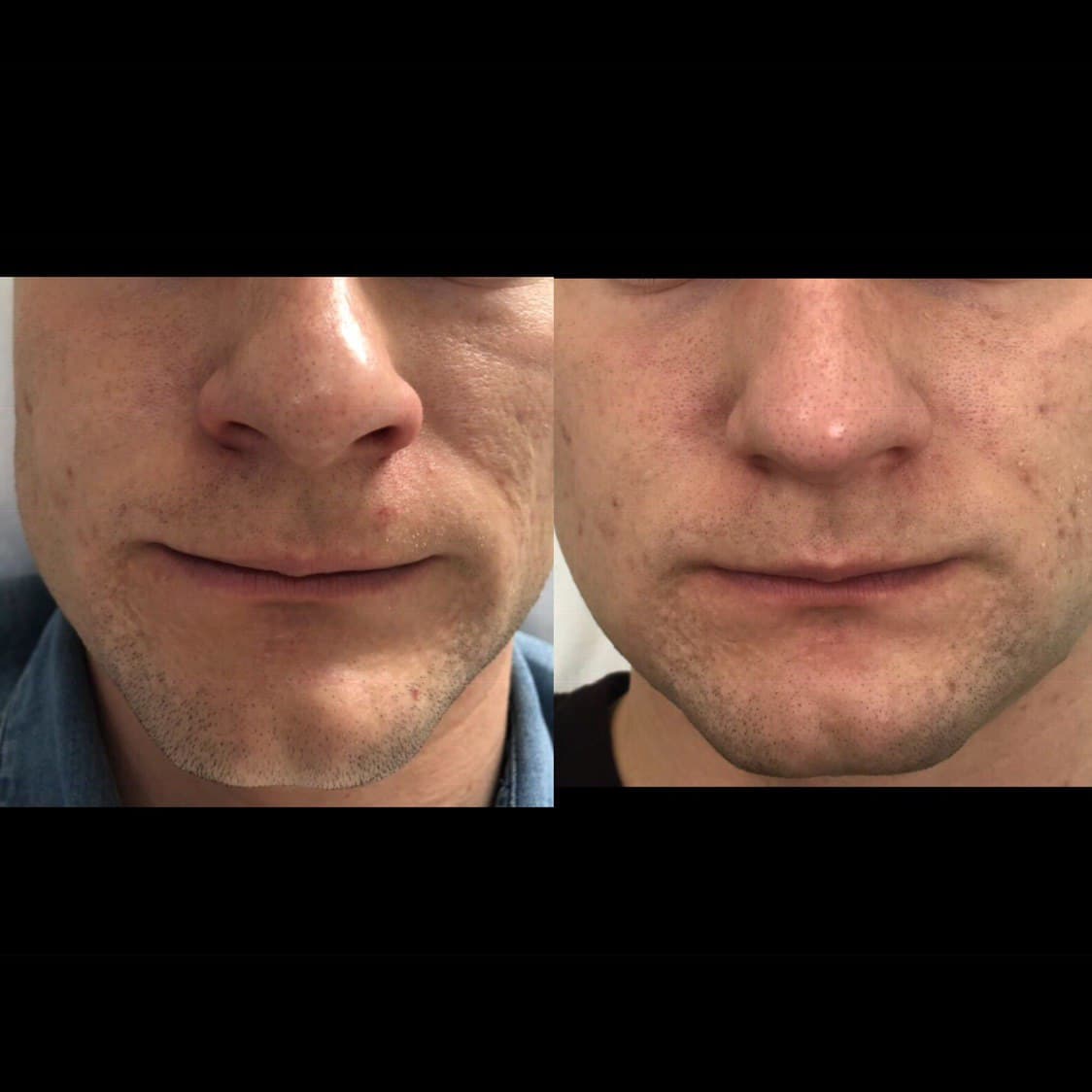 Змінити форму носа