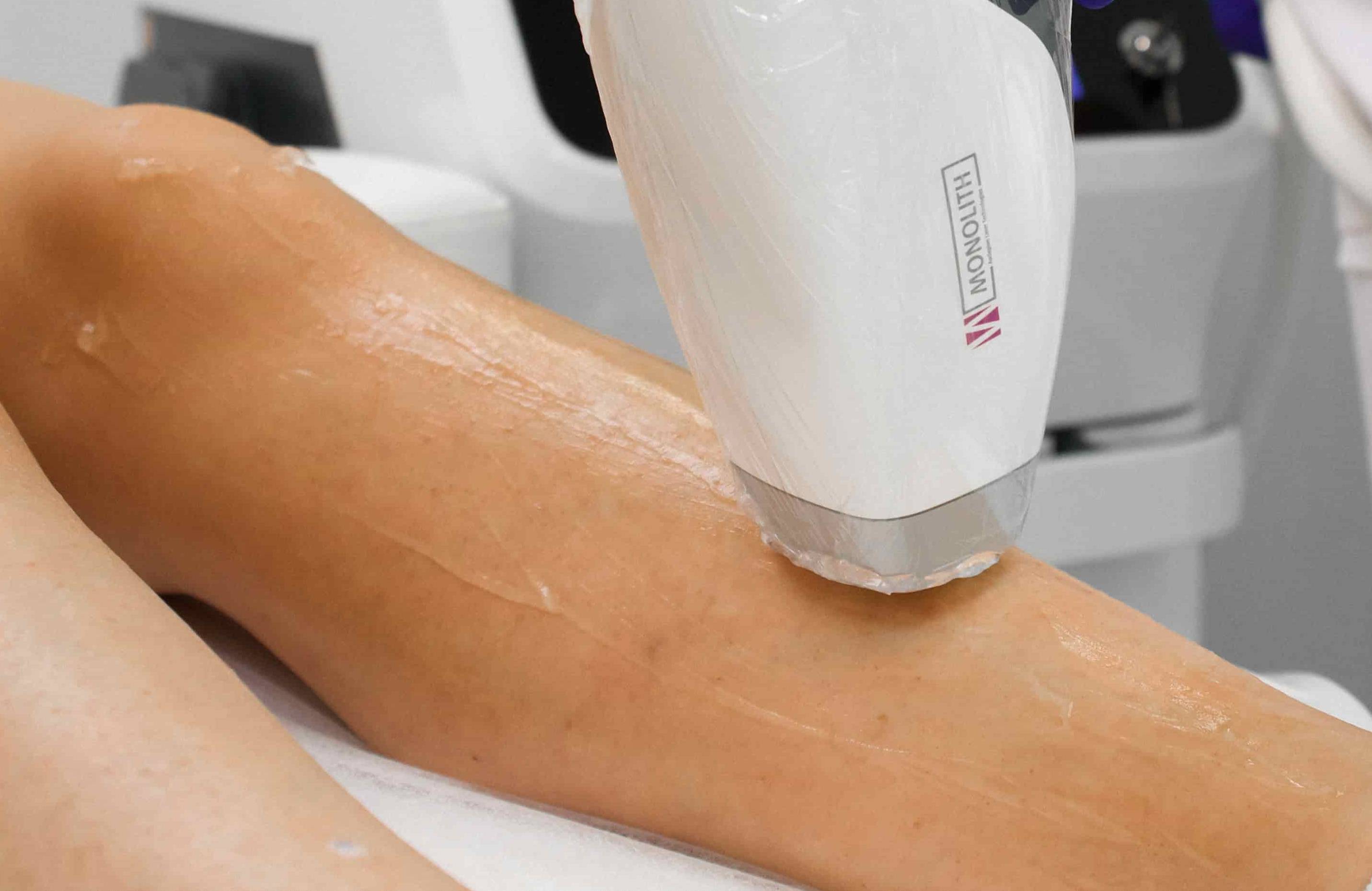 Лазерна епіляція