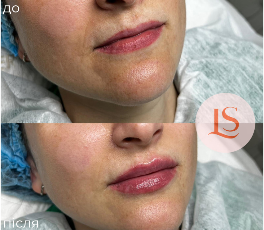 Збільшення губ-_10 Збільшення губ-_10