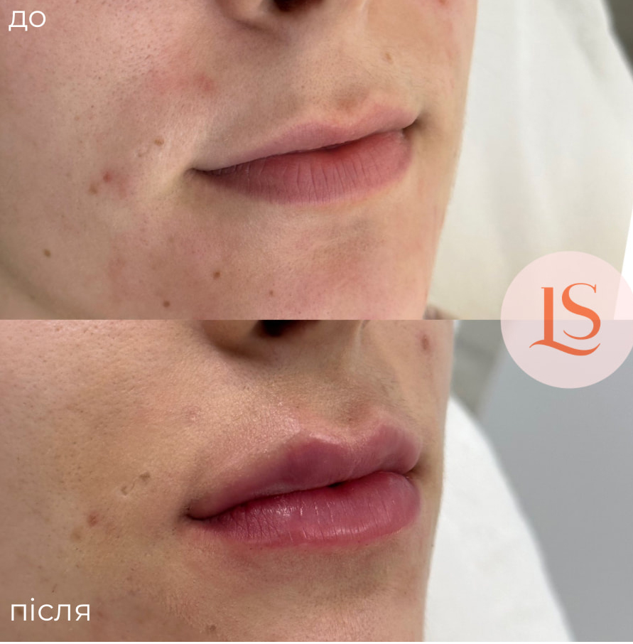 Збільшення губ-_10 Збільшення губ-_10