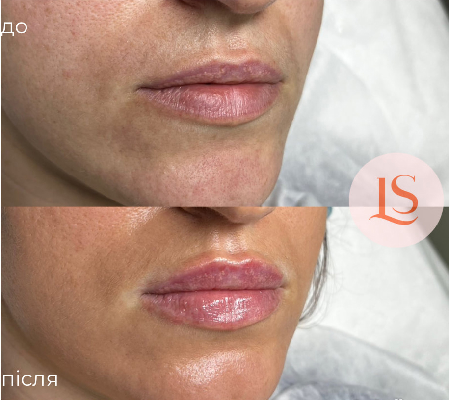 Збільшення губ-_10 Збільшення губ-_10