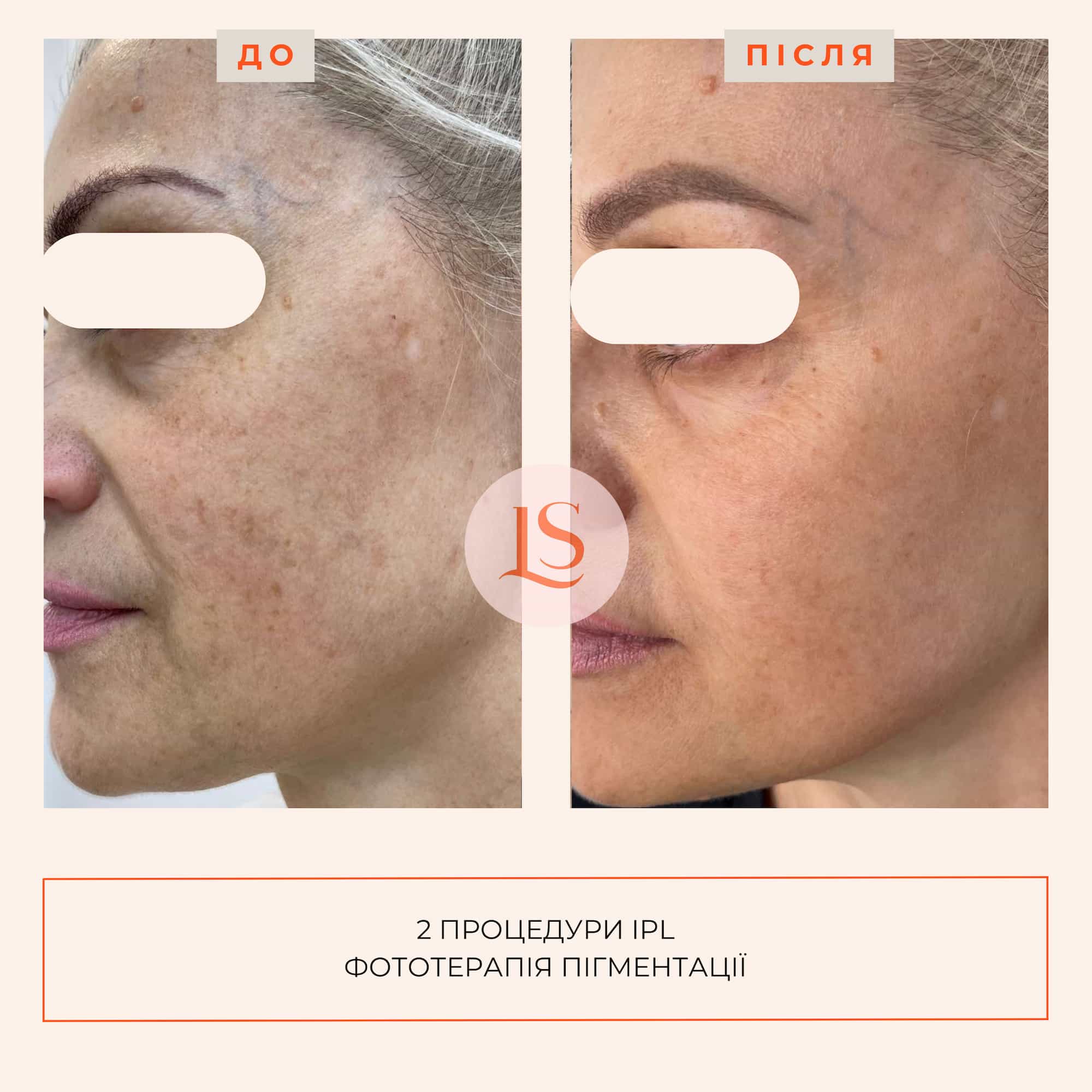 Фототерапія IPL-_8