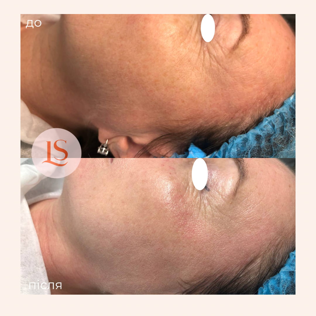 Гідропілінг-_8 Гідропілінг-_8