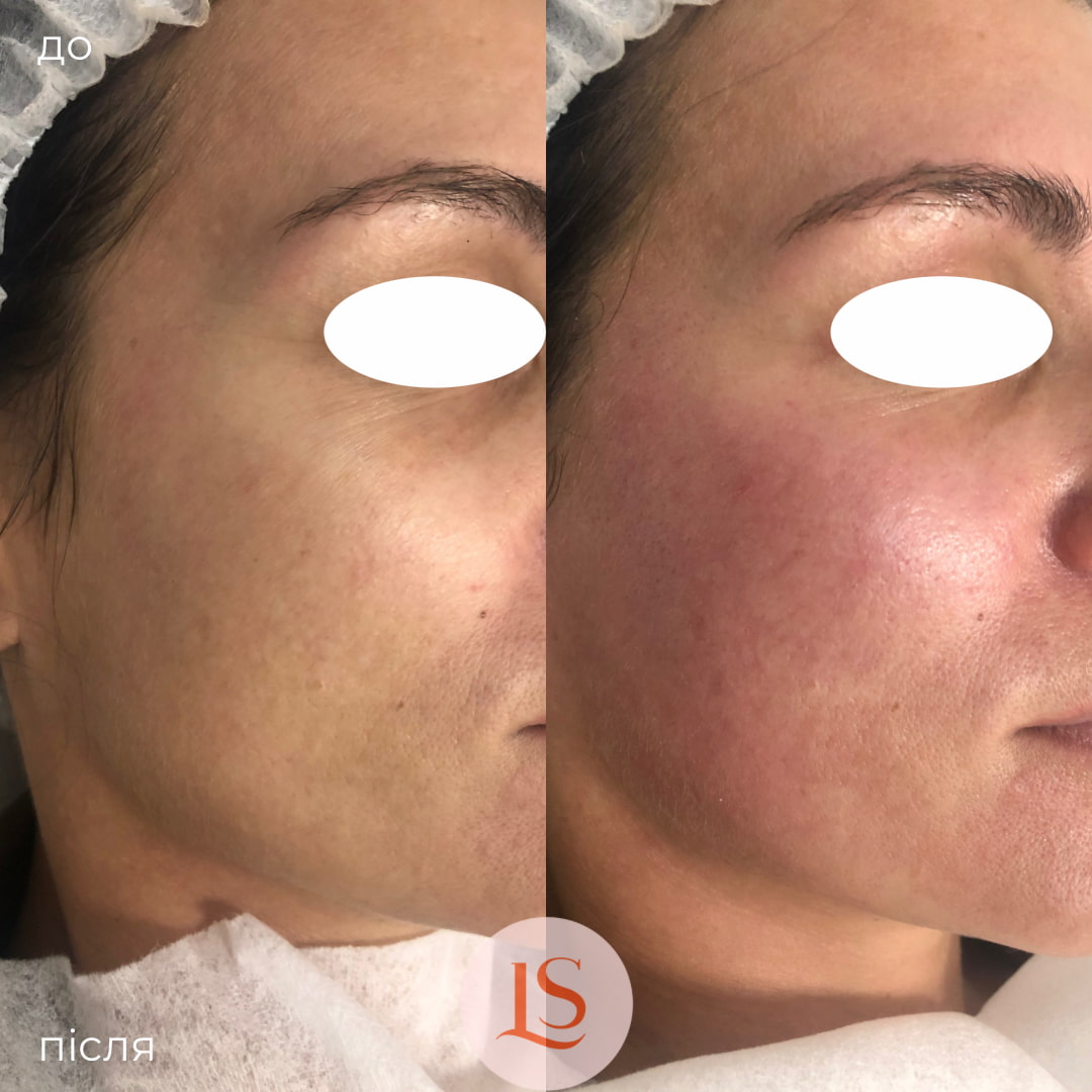 Гідропілінг-_9 Гідропілінг-_9