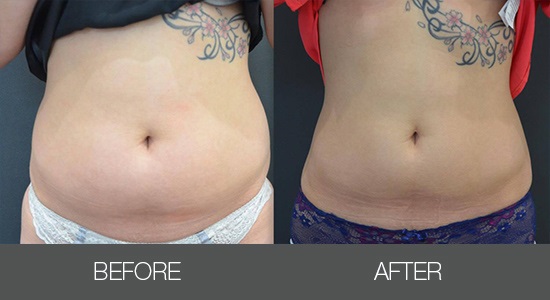 Кріоліполіз Cristal-_4