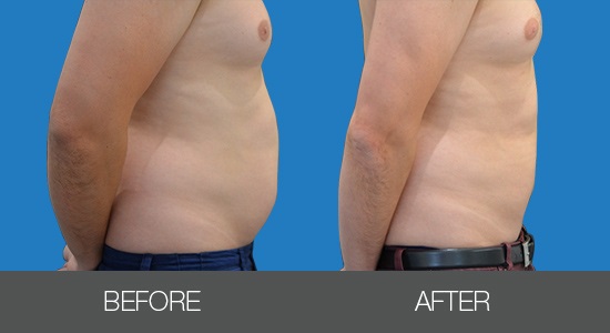 Кріоліполіз Cristal-_2