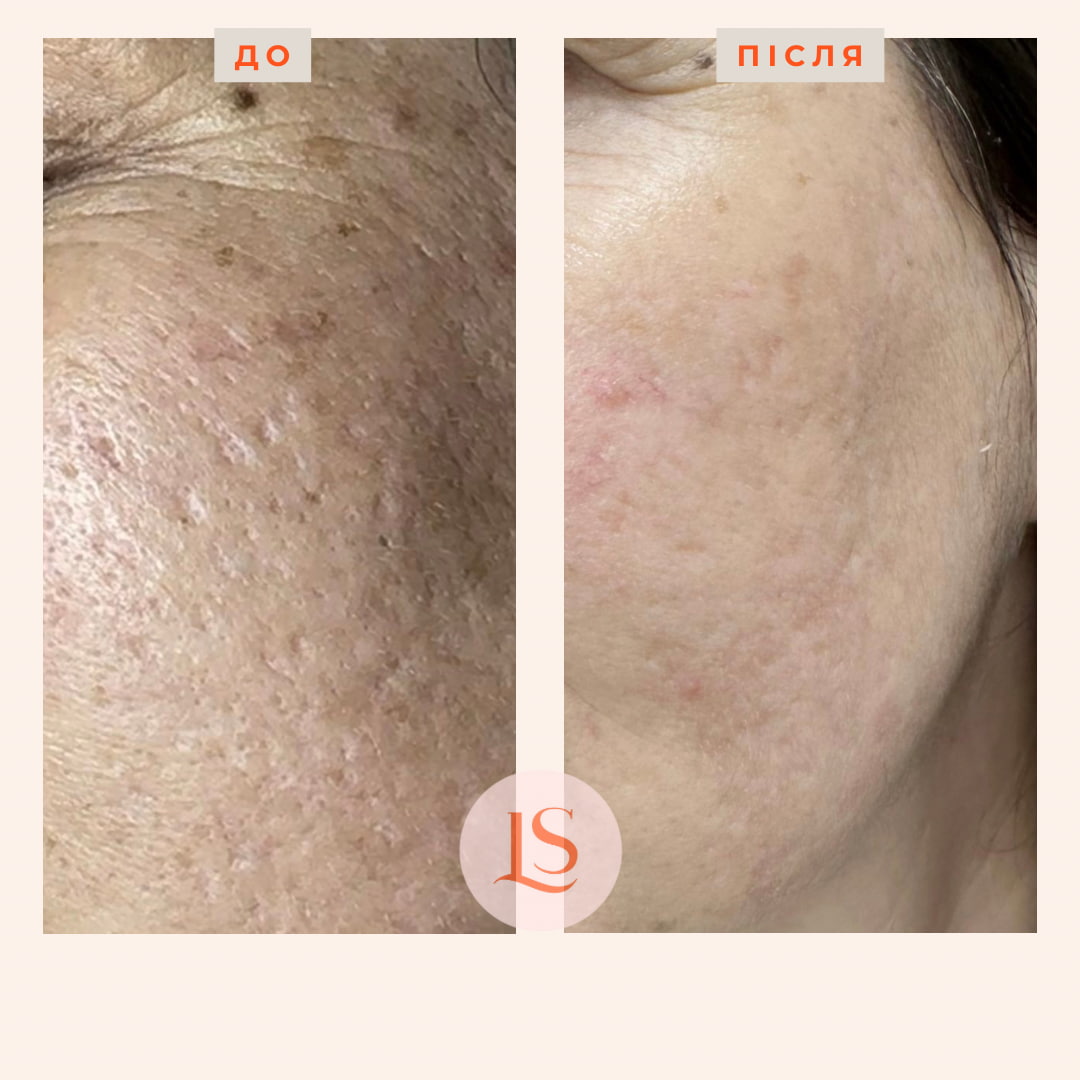 Шліфування шкіри Dermablate New-_4