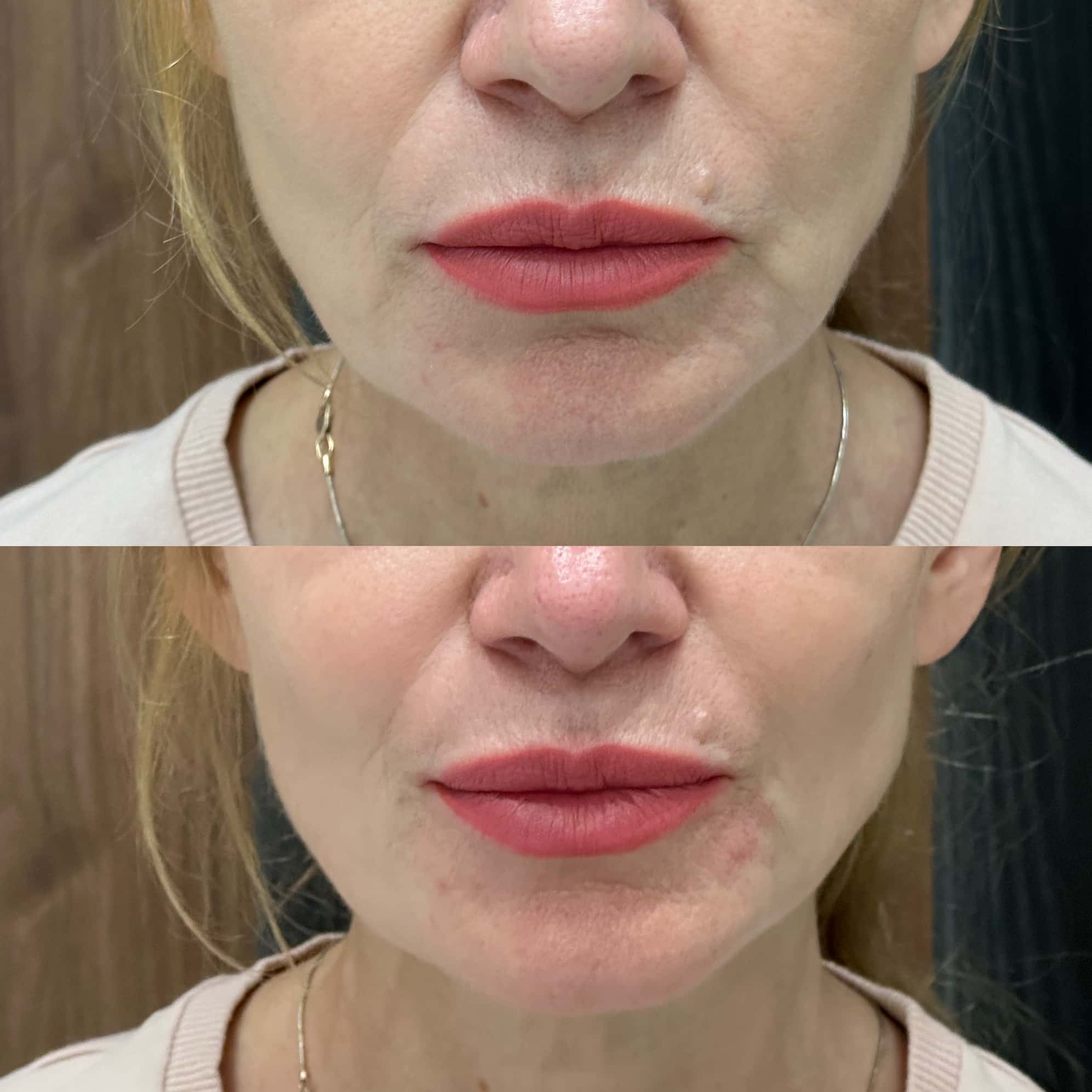 Ін'єкційна контурна пластика-_8