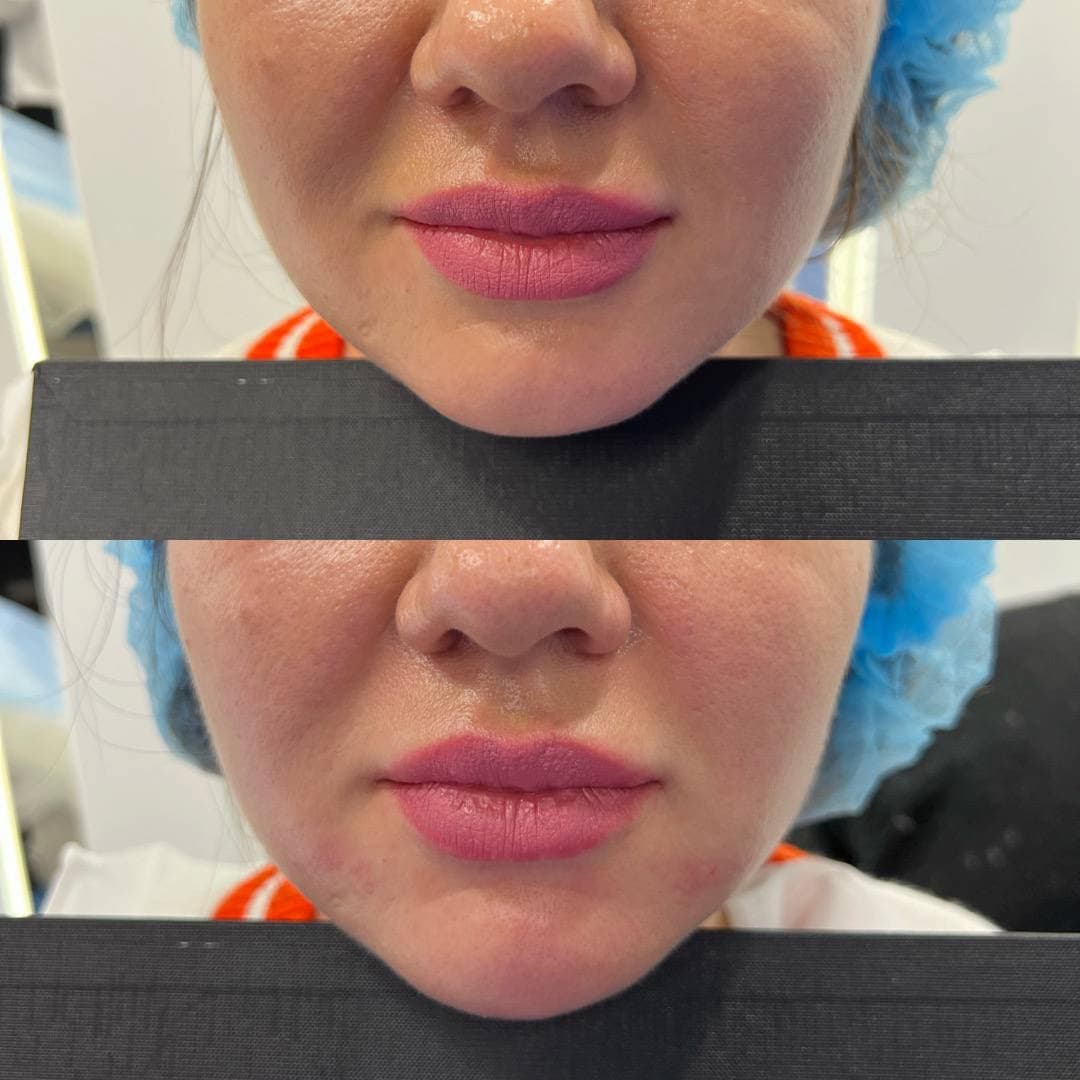 Ін'єкційна контурна пластика-_9