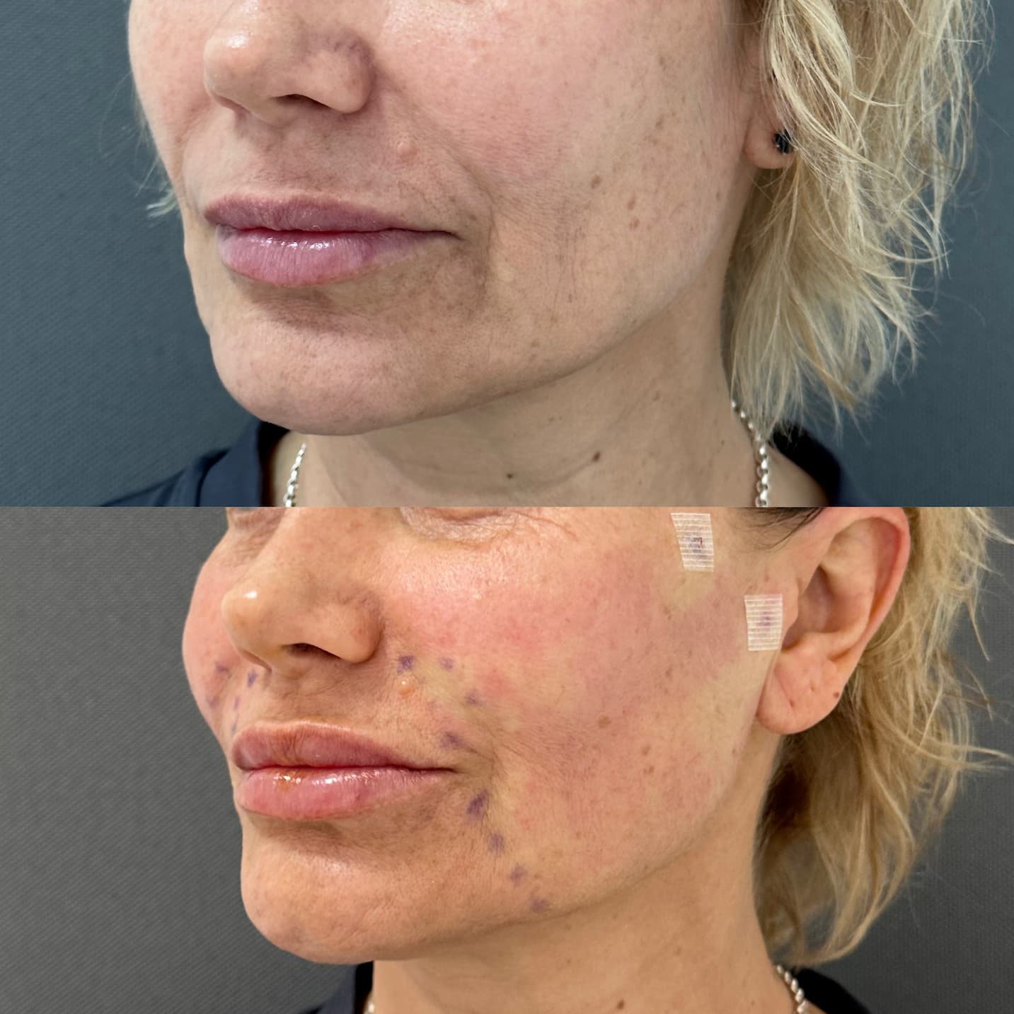 Підтяжка обличчя нитками APTOS-_3