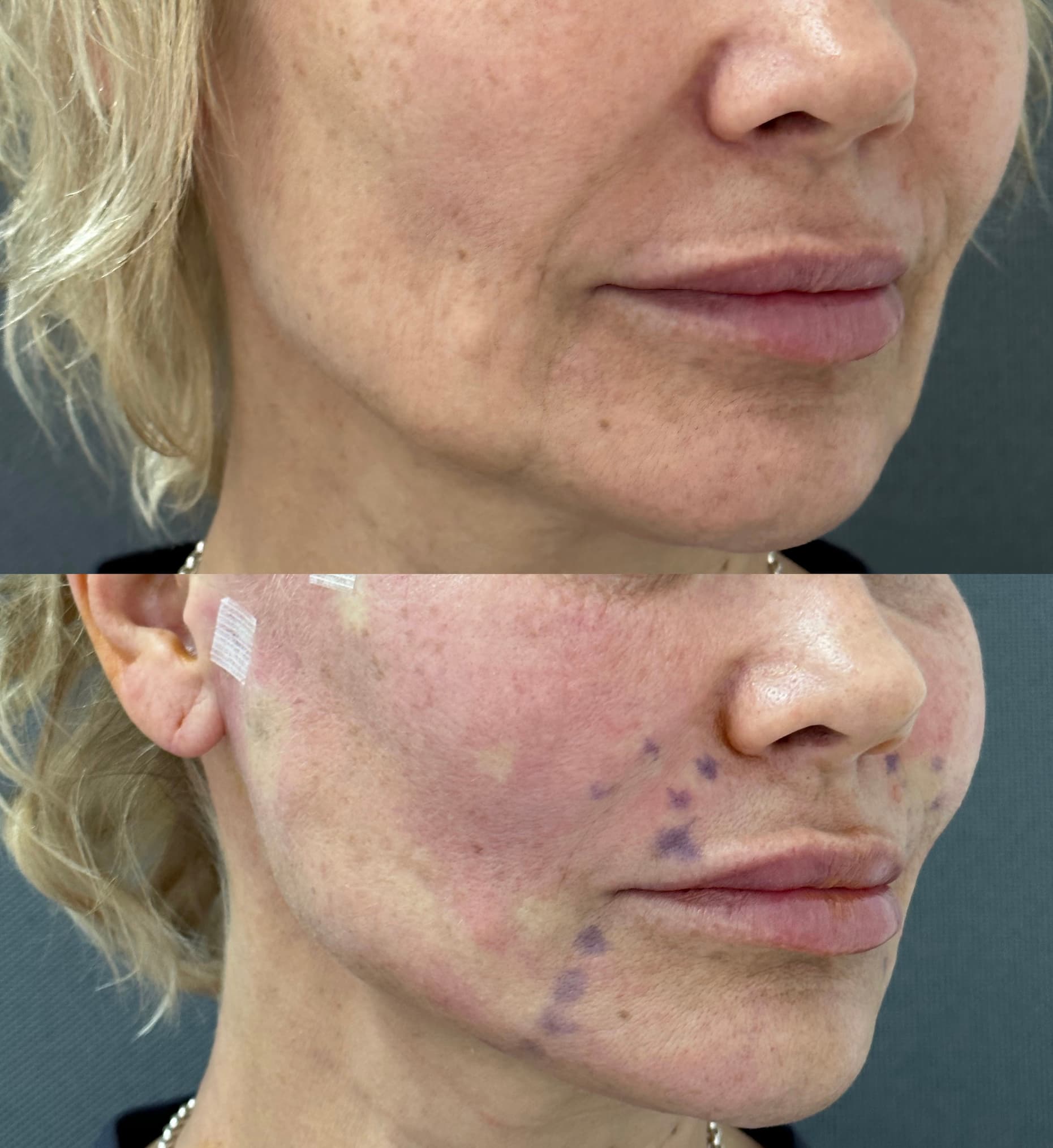 Підтяжка обличчя нитками APTOS-_4