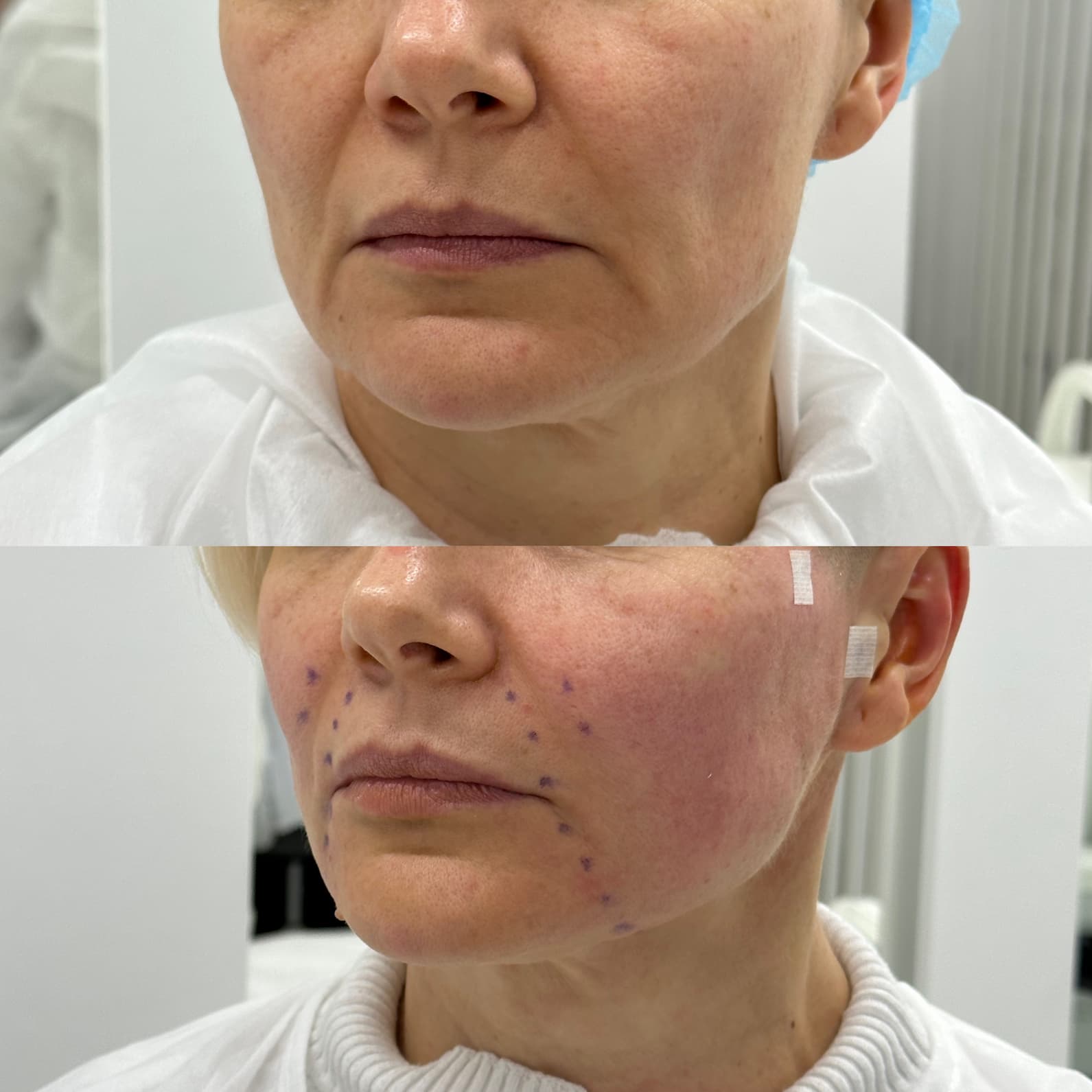 Підтяжка обличчя нитками APTOS-_2