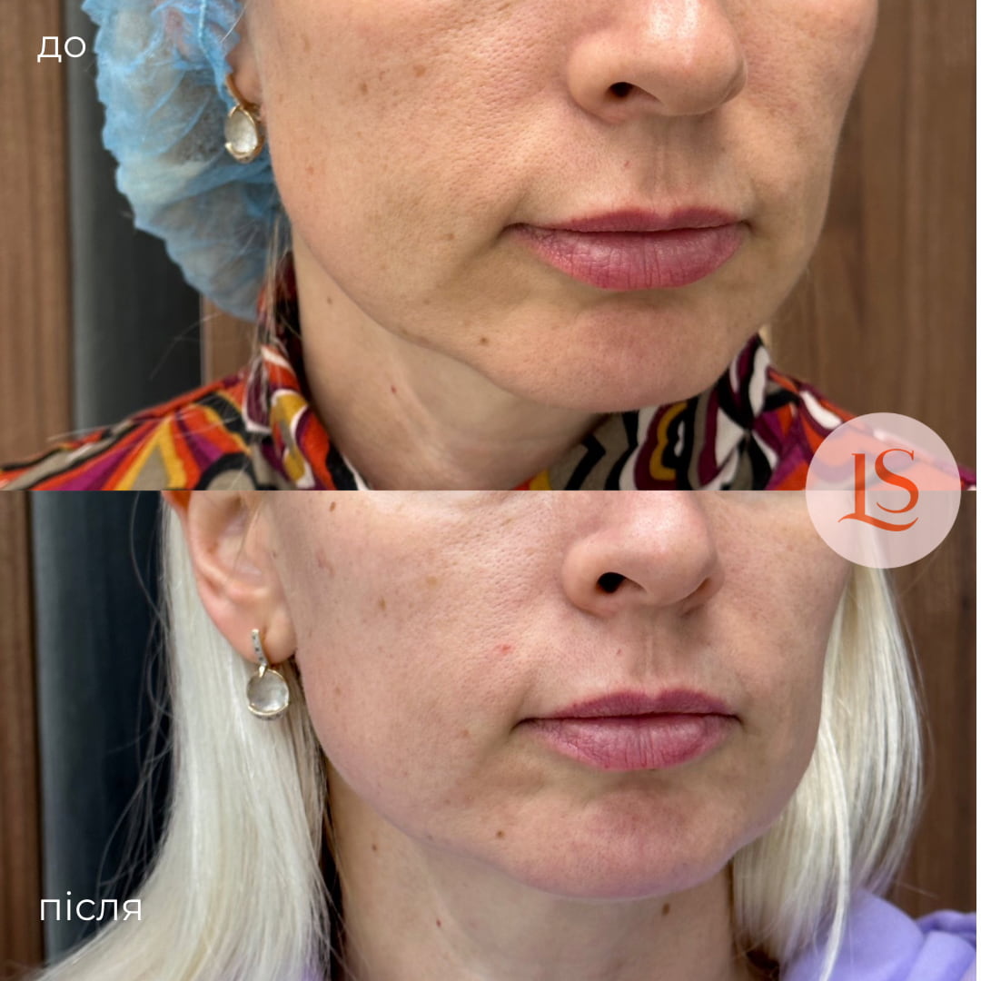 SMAS-ліфтинг-_6 SMAS-ліфтинг-_6