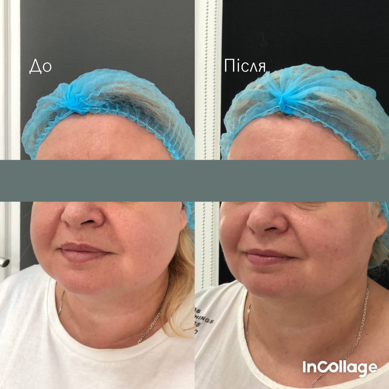 Ліфтинг обличчя Agnes-_2