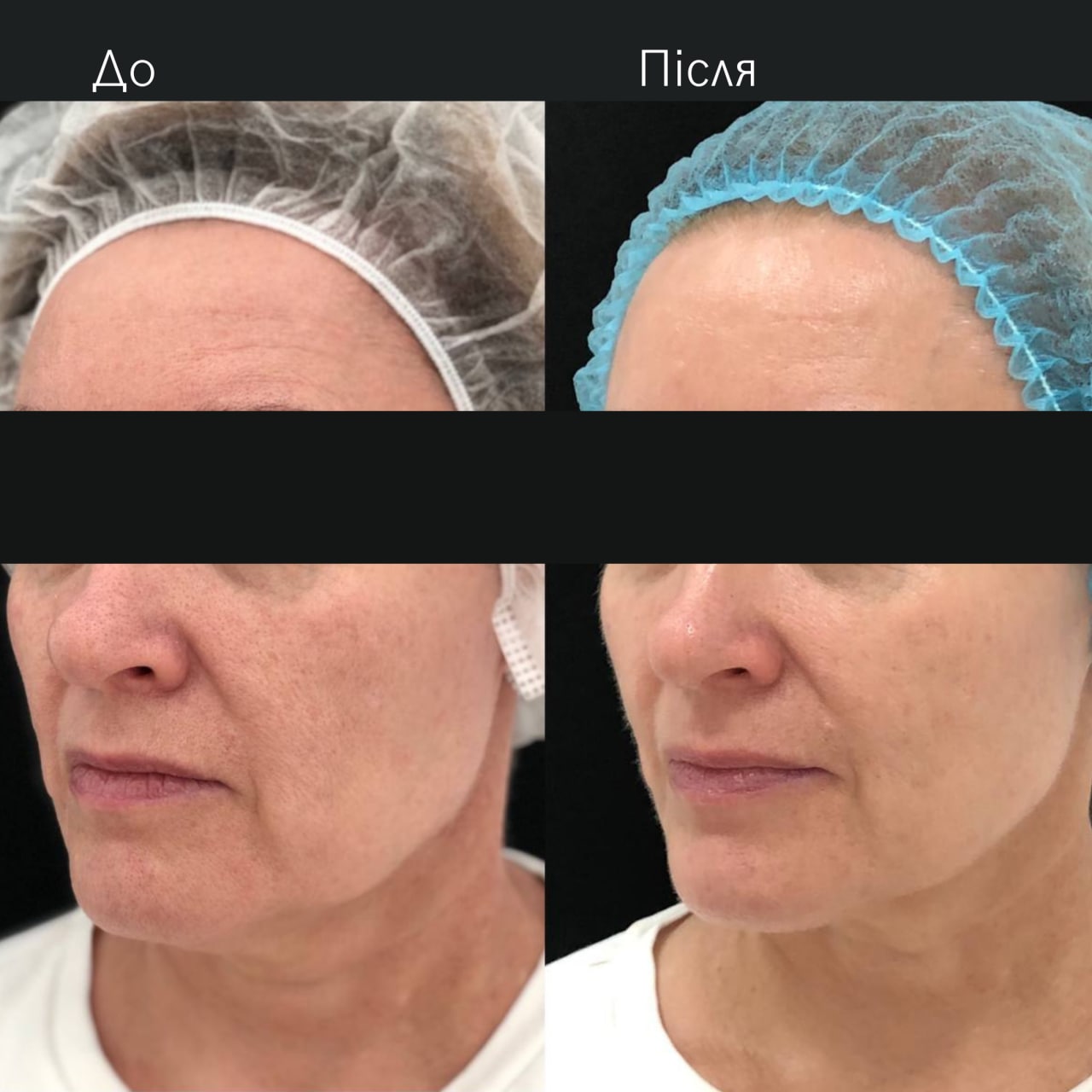 Ліфтинг обличчя Agnes-_3