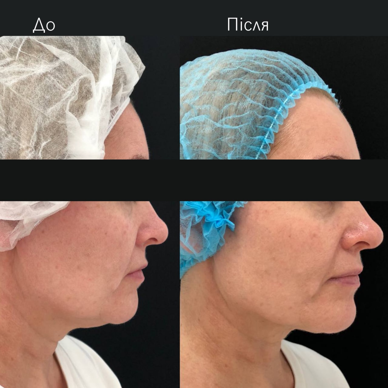 Ліфтинг обличчя Agnes-_6