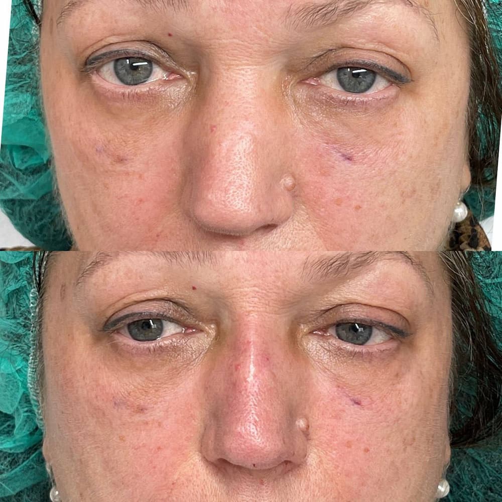 Ін'єкційна контурна пластика-_2