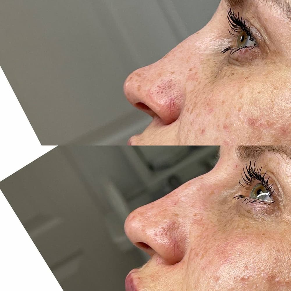 Ін'єкційна контурна пластика-_3