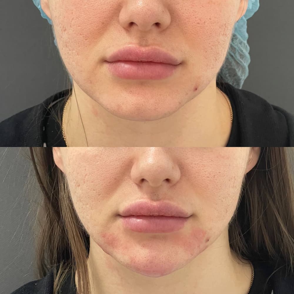 Ін'єкційна контурна пластика-_5