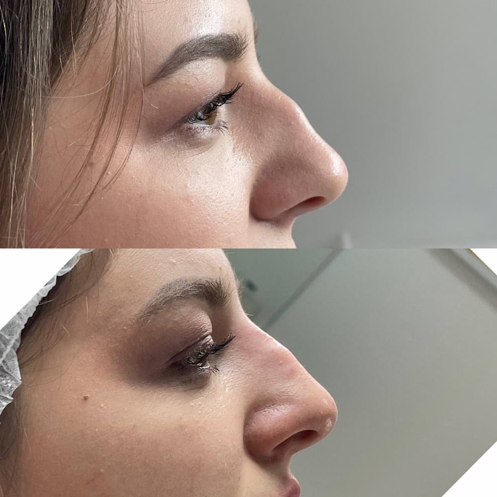 Ін'єкційна контурна пластика-_6