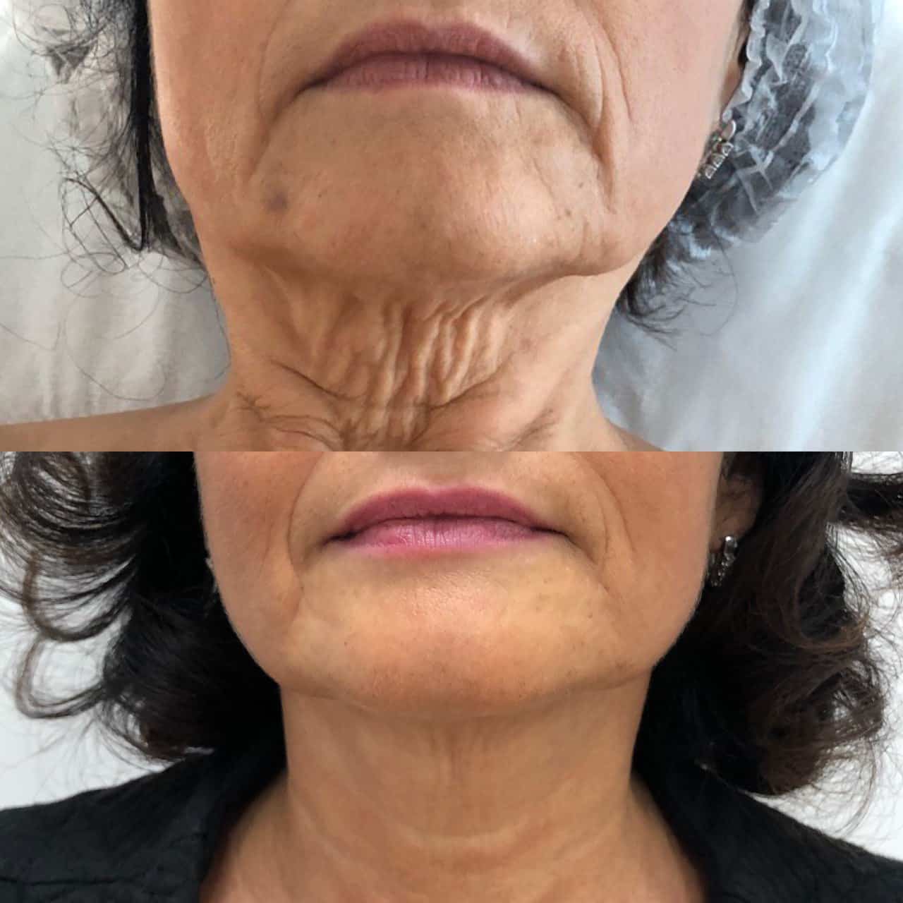 Мікроголковий RF ліфтинг EndyMed-_3