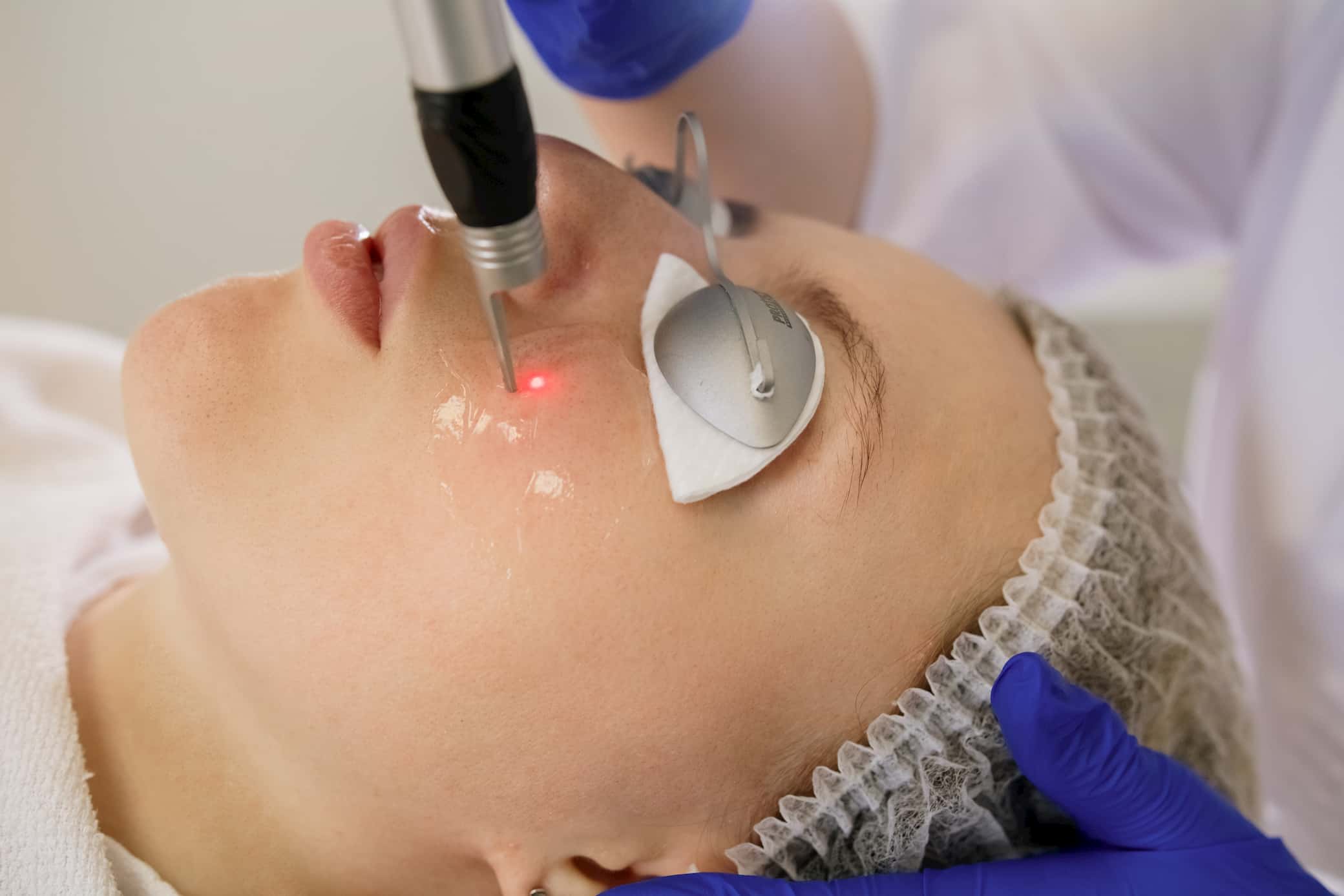 Лазерне видалення судин у Львові-_5